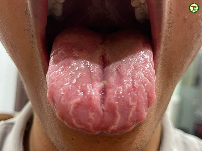 Viêm lưỡi bản đồ nặng